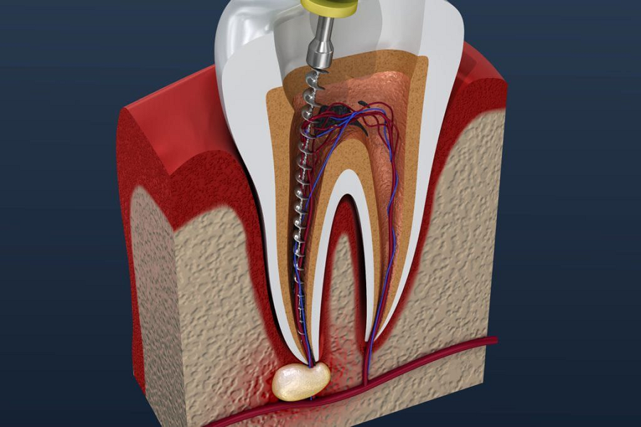 Root Canal and Process for Treatment