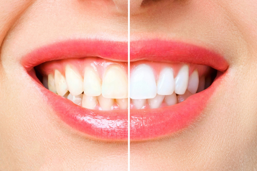How Dental Veneers Remove the Dental Gaps