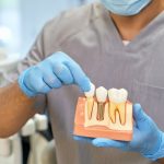 Top 5 Compelling Reasons to Get Dental Implants