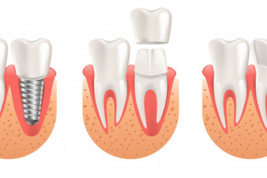 Dental Veneers Closing Gap Process