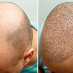What Are The Precautionary Measures Should Be Followed After Hair Transplant