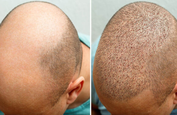 What Are The Precautionary Measures Should Be Followed After Hair Transplant?