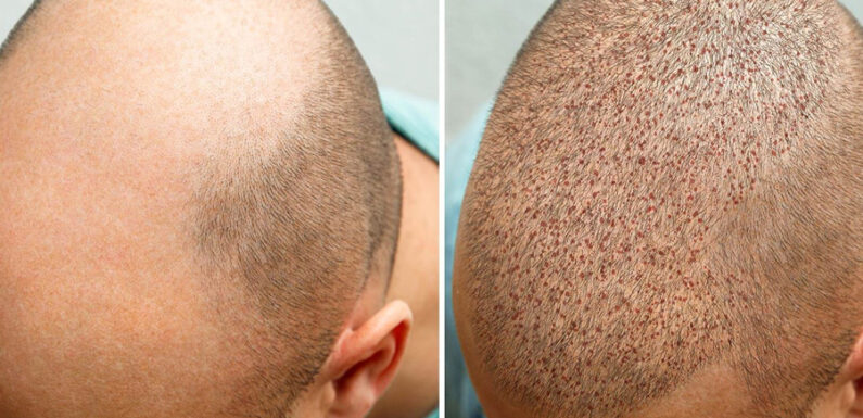 What Are The Precautionary Measures Should Be Followed After Hair Transplant?