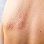 Shingles Vaccine Facts & Side Effects