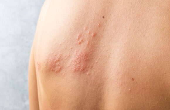 Shingles Vaccine Facts & Side Effects