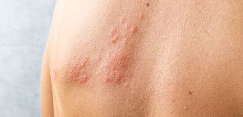 Shingles Vaccine Facts & Side Effects