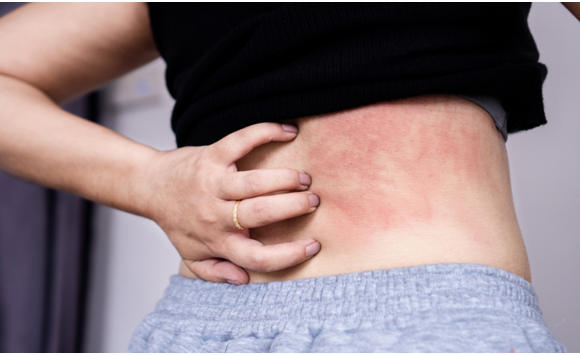 Why Do My Rashes Keep Coming Back?