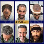 Direct Hair Implants or Direct Hair Improvements in DHI Hair Transplantation
