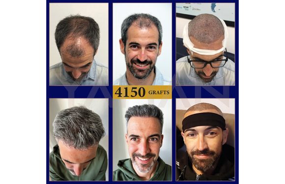 Direct Hair Implants or Direct Hair Improvements in DHI Hair Transplantation?
