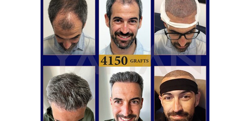Direct Hair Implants or Direct Hair Improvements in DHI Hair Transplantation?